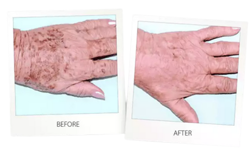 Laser Skin Resurfacing - Hands