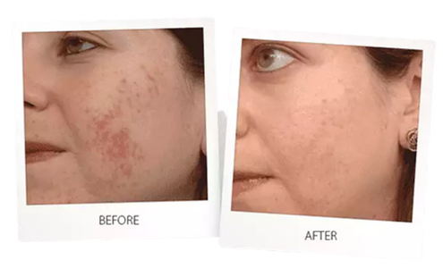 Laser Skin Resurfacing - Cheek