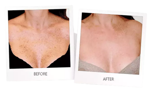 Laser Skin Resurfacing - Chest