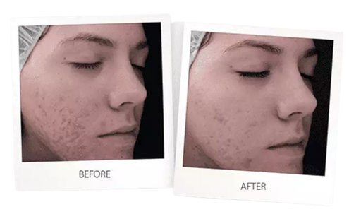 Laser Skin Resurfacing - Face