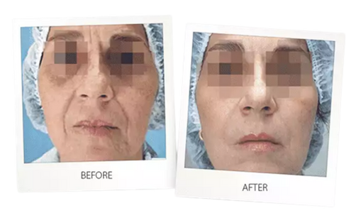 Laser Skin Resurfacing Facial Results