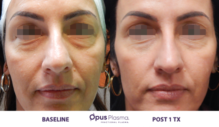 Laser Skin Resurfacing B&F 4