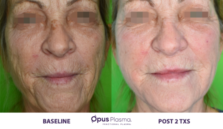 Laser Skin Resurfacing B&F 3