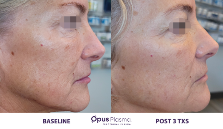 Laser Skin Resurfacing B&F 2